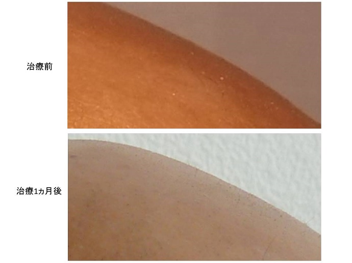 円形脱毛症　病院""